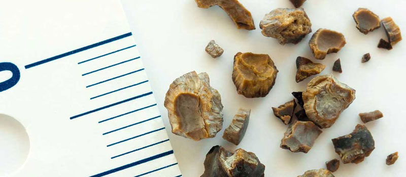 stone-piles-urine-infections-treatment